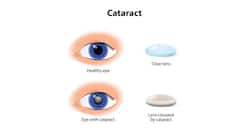 Are Indians at a higher risk of getting cataracts?