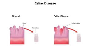 Infections during early life may increase celiac disease risk