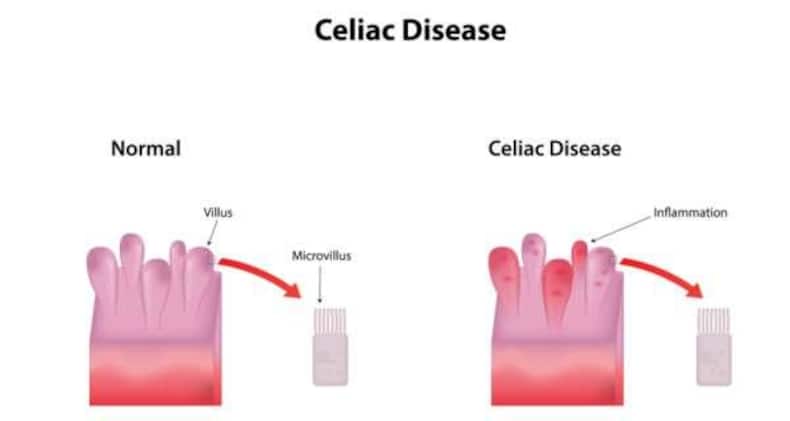 celiac disease