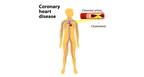 Coronary heart disease