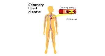 Coronary heart disease
