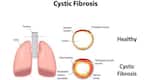 Cystic fibrosis