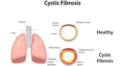 Cystic Fibrosis: Symptoms, Stages, Causes And More