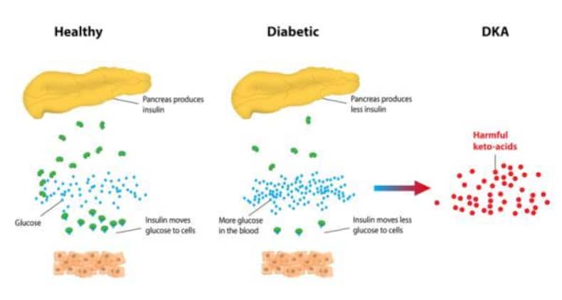 diabetic ketoacidosis