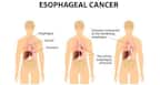 Esophageal cancer