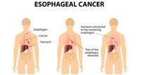 Esophageal cancer