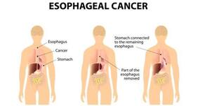 Gum disease has been linked to esophageal cancer: Study