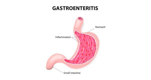 Se puede comer aguacate con gastroenteritis