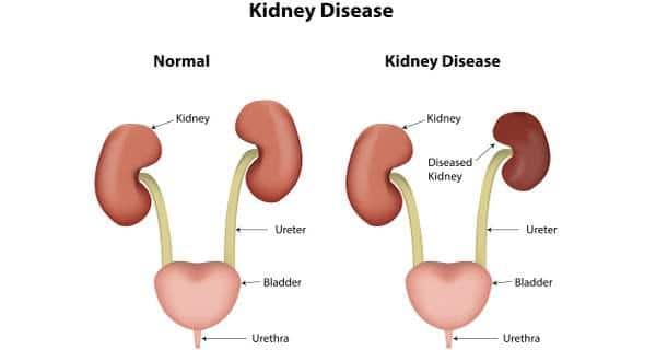 kdiney disease