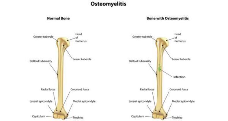 osteomyelitis