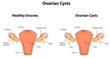 Ovarian Cyst Rupture – symptoms and causes | TheHealthSite.com