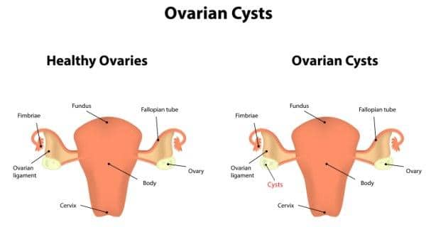 Symptoms ovarian cyst 4 Ovarian