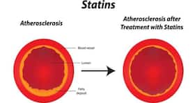 Cholesterol lowering drugs can be used to treat blindness