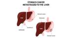 Stomach cancer