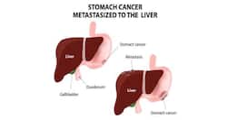 Simple breath test to detect stomach cancer
