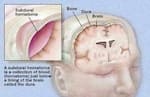 Chronic subdural haematoma