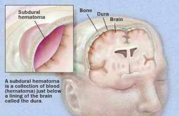 chronic subdural hematoma