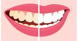 Instantly remove tea/coffee stains from your teeth
