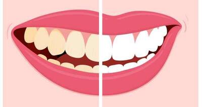 Instantly remove tea/coffee stains from your teeth