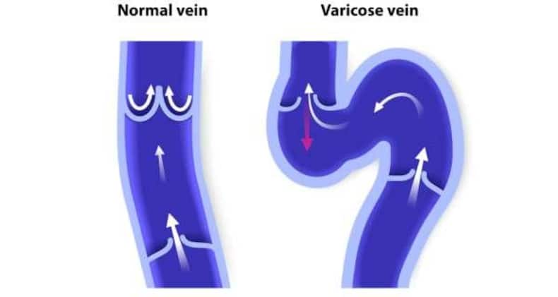 varicose-veins