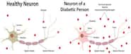 Diabetic neuropathy