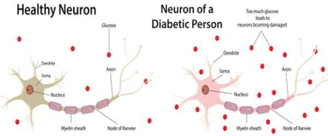 diabetic-neuropathy