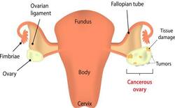 рдирдП рдХрд┐рд╕реНрдо рдХреЗ рдЕрд▓реНрдЯреНрд░рд╛рд╕рд╛рдЙрдВрдб рд╕реЗ рдорд┐рд▓реЗрдЧреА рдУрд╡рд░рд┐рдпрди рдХреИрдВрд╕рд░ рд╣реЛрдиреЗ рдХреЗ рдЦрддрд░реЗ рдХреА рдкреВрд░реНрд╡рд╕реВрдЪрдирд╛