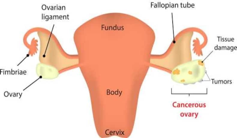ovarian cancer