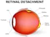 Blurred vision may indicate retinal disease, says study