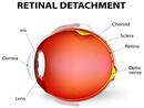 Blurred vision may indicate retinal disease, says study