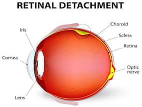 Blurred vision may indicate retinal disease, says study