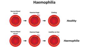 World Hemophilia Day 2018: 5 interesting facts about hemophilia