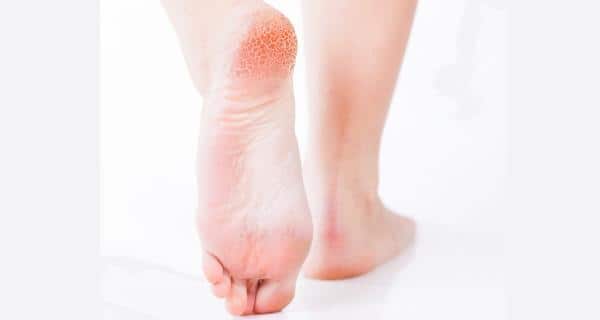 Ayurveda Treatment for Cracked Heels | Ayurclinic Melbourne