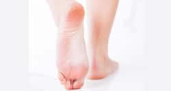 10 hidden causes of cracked heels you probably didn’t know!