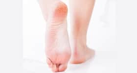 10 hidden causes of cracked heels you probably didn’t know!