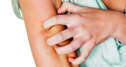 Ouch! Home remedies for insect bites