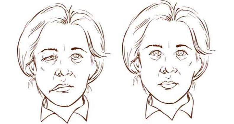 7 symptoms of a stroke you should not ignore