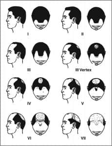 male pattern baldness