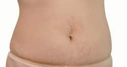 This home remedy to lighten stretch marks WORKS!