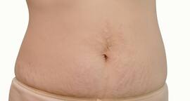 This home remedy to lighten stretch marks WORKS!