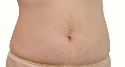 This home remedy to lighten stretch marks WORKS!