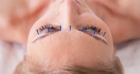 Acupuncture -- all you need to know