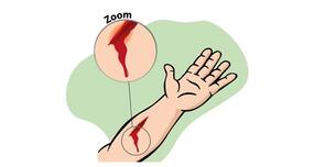 First aid for cuts and bleeding