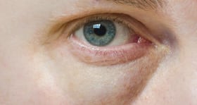 Tired eyes? Use these ingredients from your kitchen to get rid of puffiness