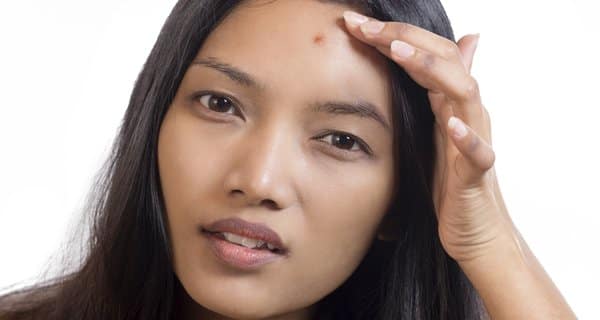 Expert recommended diet plan for acne free skin