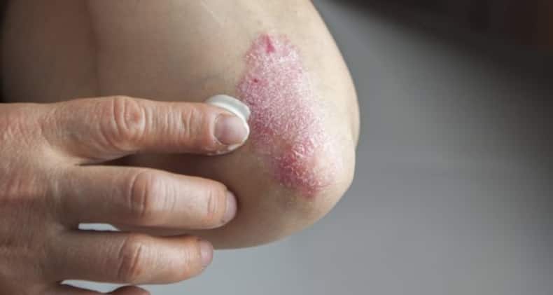World Psoriasis Day -- 8 tips to manage psoriasis during winter