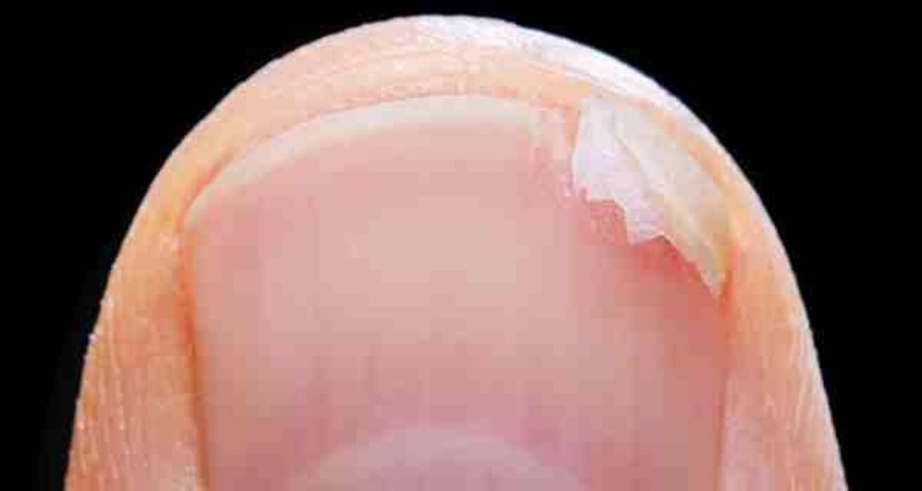7 symptoms of zinc deficiency you should watch out for