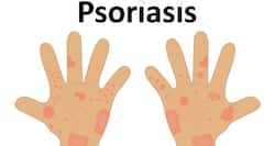 World Psoriasis Day -- 8 tips to manage psoriasis during winter