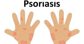 World Psoriasis Day -- 8 tips to manage psoriasis during winter