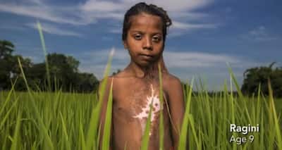 This burn victim's reaction after looking at the sky will leave you teary-eyed